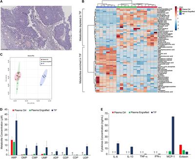 Metabolites Profiling of Melanoma Interstitial Fluids Reveals Uridine Diphosphate as Potent Immune Modulator Capable of Limiting Tumor Growth